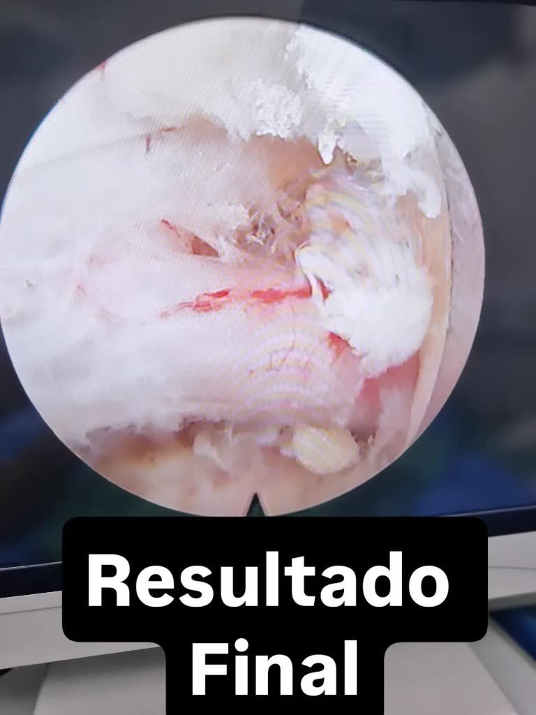 Imagem da câmera endoscópica ao fim da descompressão