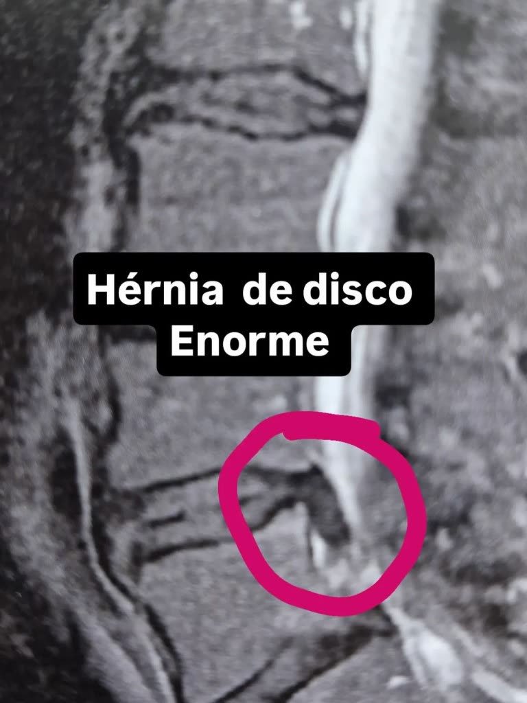 Ressonância com hérnia de disco volumosa destacada